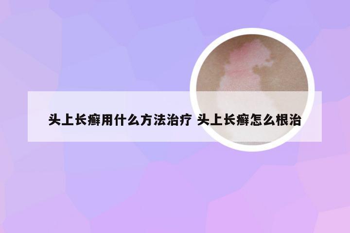 头上长癣用什么方法治疗 头上长癣怎么根治