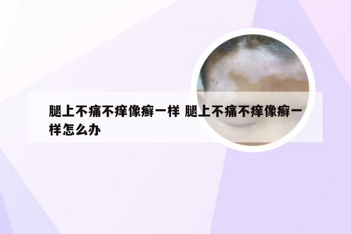 腿上不痛不痒像癣一样 腿上不痛不痒像癣一样怎么办