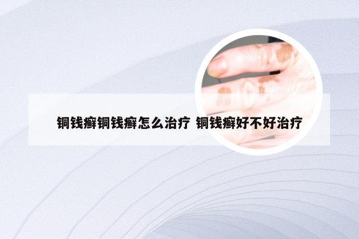 铜钱癣铜钱癣怎么治疗 铜钱癣好不好治疗