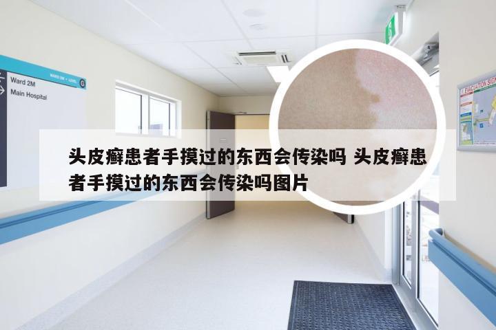 头皮癣患者手摸过的东西会传染吗 头皮癣患者手摸过的东西会传染吗图片