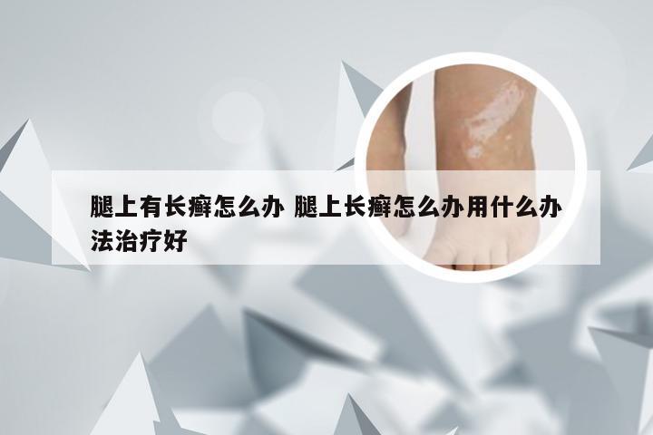 腿上有长癣怎么办 腿上长癣怎么办用什么办法治疗好