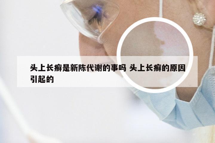 头上长癣是新陈代谢的事吗 头上长癣的原因引起的