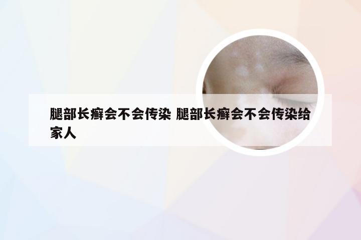 腿部长癣会不会传染 腿部长癣会不会传染给家人