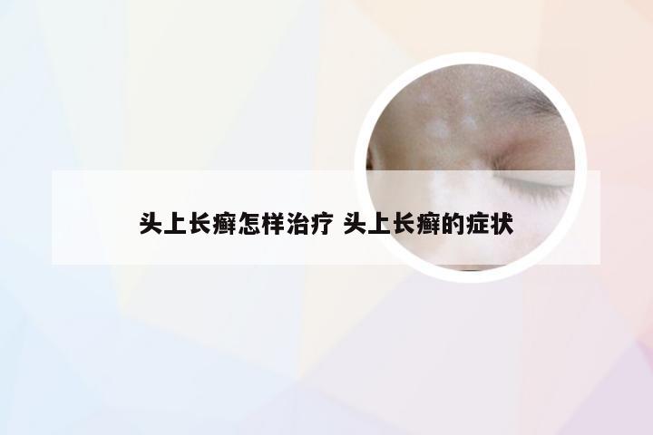 头上长癣怎样治疗 头上长癣的症状