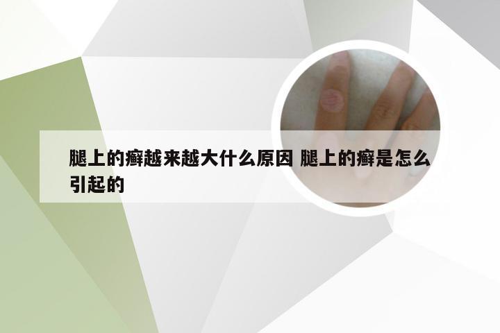 腿上的癣越来越大什么原因 腿上的癣是怎么引起的