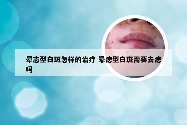 晕志型白斑怎样的治疗 晕痣型白斑需要去痣吗