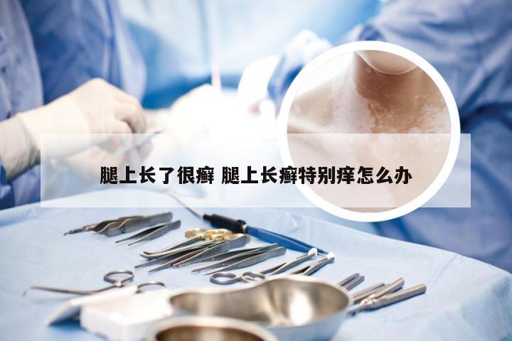 腿上长了很癣 腿上长癣特别痒怎么办