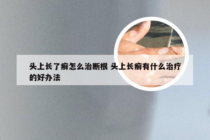 头上长了癣怎么治断根 头上长癣有什么治疗的好办法