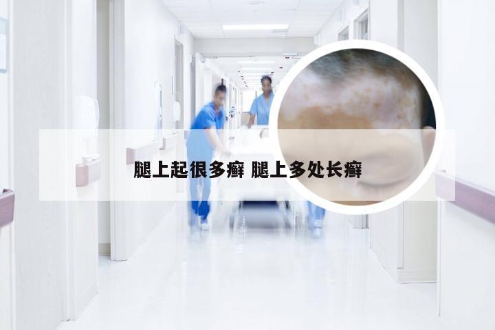 腿上起很多癣 腿上多处长癣