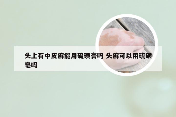 头上有中皮癣能用硫磺膏吗 头癣可以用硫磺皂吗