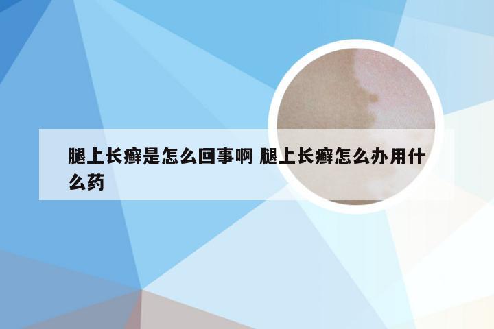 腿上长癣是怎么回事啊 腿上长癣怎么办用什么药