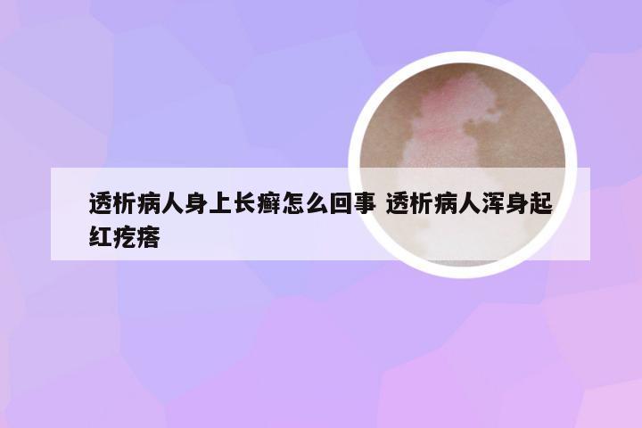 透析病人身上长癣怎么回事 透析病人浑身起红疙瘩