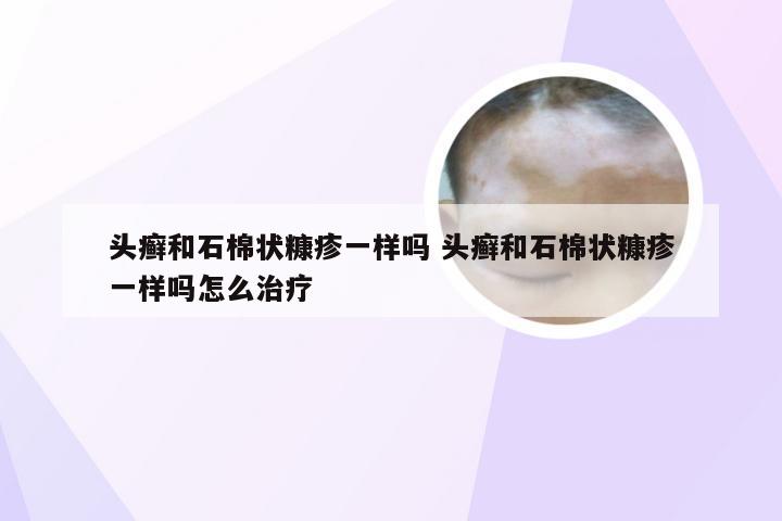 头癣和石棉状糠疹一样吗 头癣和石棉状糠疹一样吗怎么治疗