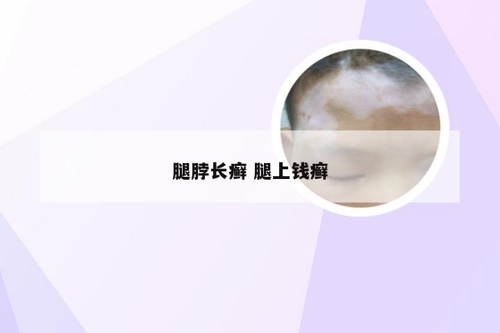 腿脖长癣 腿上钱癣