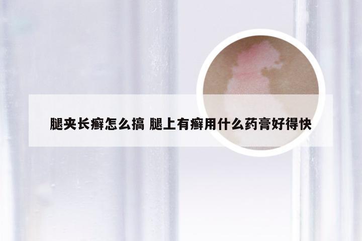 腿夹长癣怎么搞 腿上有癣用什么药膏好得快