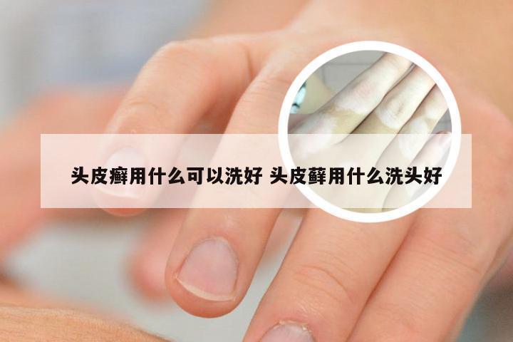 头皮癣用什么可以洗好 头皮藓用什么洗头好