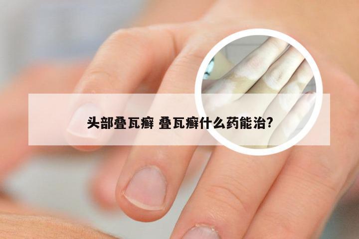 头部叠瓦癣 叠瓦癣什么药能治?