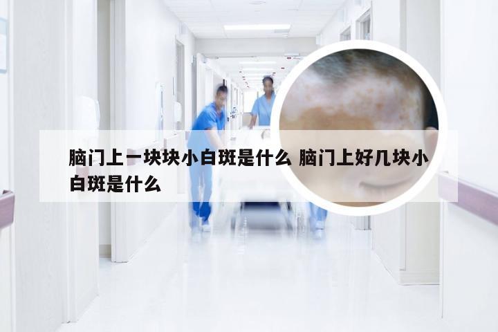 脑门上一块块小白斑是什么 脑门上好几块小白斑是什么