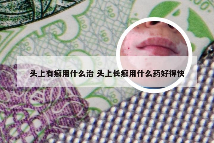 头上有癣用什么治 头上长癣用什么药好得快