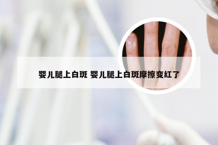 婴儿腿上白斑 婴儿腿上白斑摩擦变红了