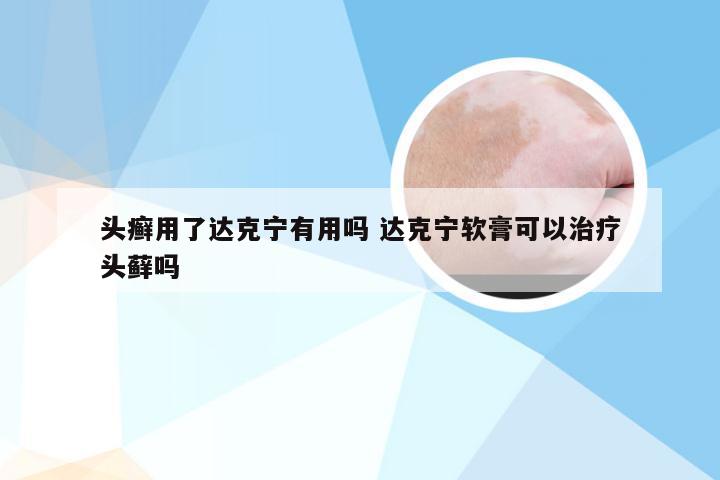 头癣用了达克宁有用吗 达克宁软膏可以治疗头藓吗