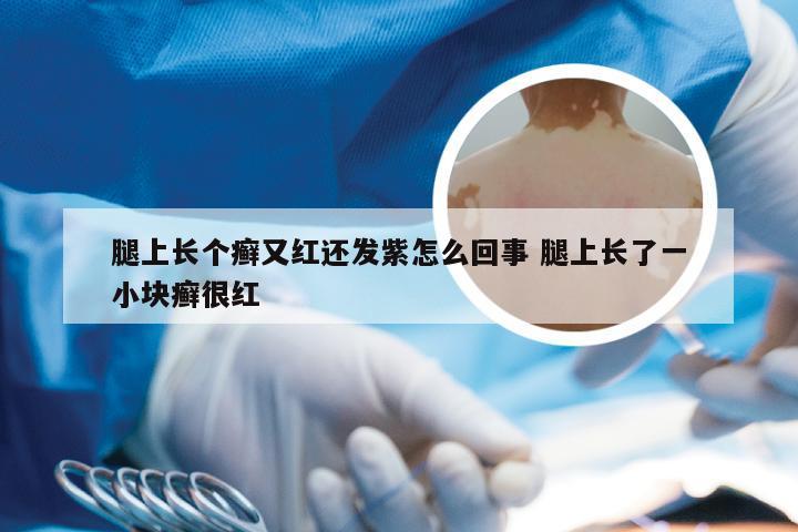 腿上长个癣又红还发紫怎么回事 腿上长了一小块癣很红