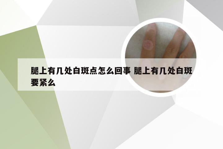 腿上有几处白斑点怎么回事 腿上有几处白斑要紧么