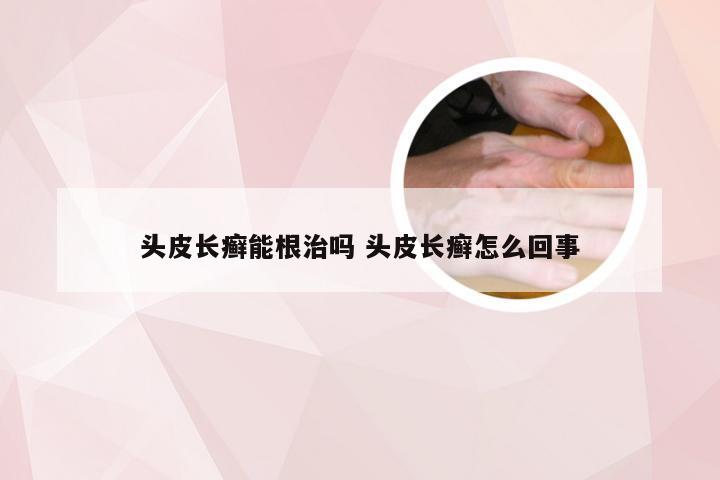 头皮长癣能根治吗 头皮长癣怎么回事