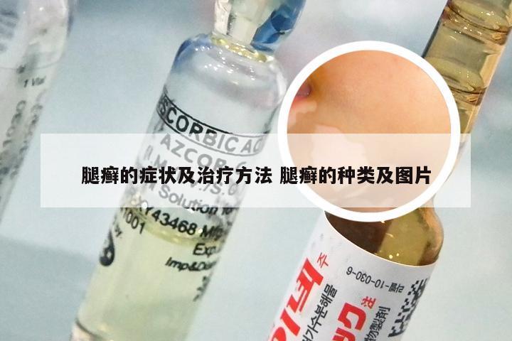 腿癣的症状及治疗方法 腿癣的种类及图片