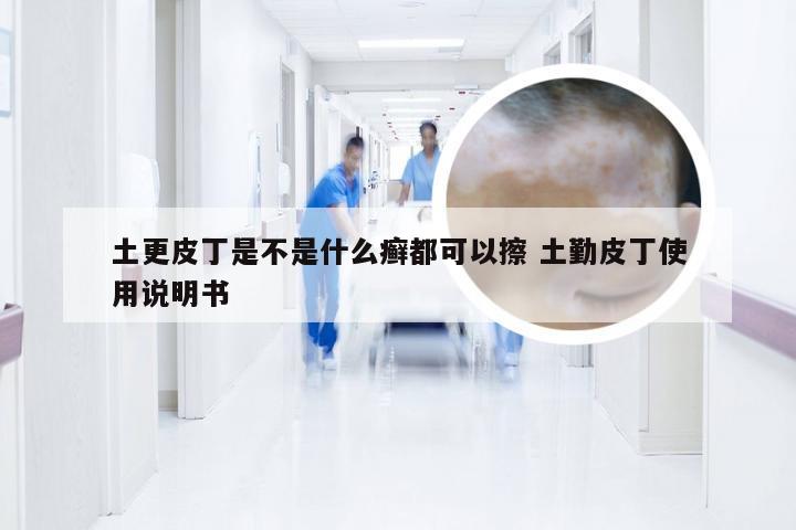 土更皮丁是不是什么癣都可以擦 土勤皮丁使用说明书