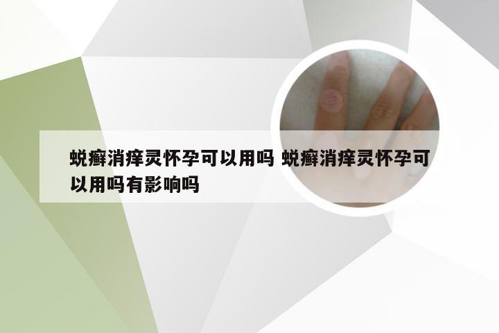 蜕癣消痒灵怀孕可以用吗 蜕癣消痒灵怀孕可以用吗有影响吗