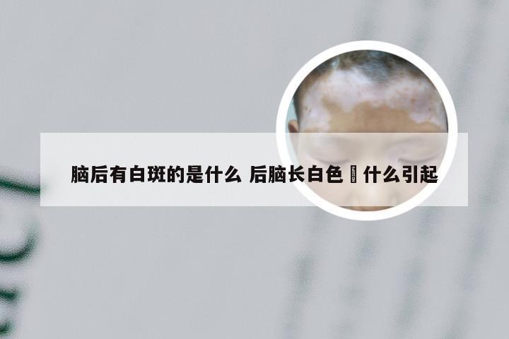 脑后有白斑的是什么 后脑长白色廯什么引起