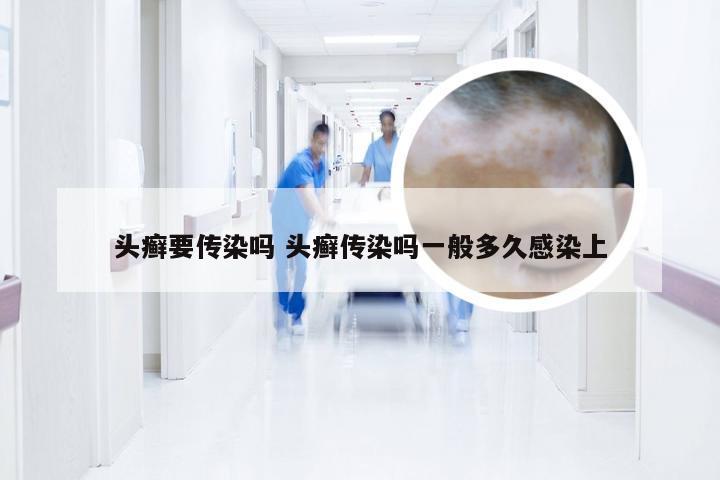 头癣要传染吗 头癣传染吗一般多久感染上