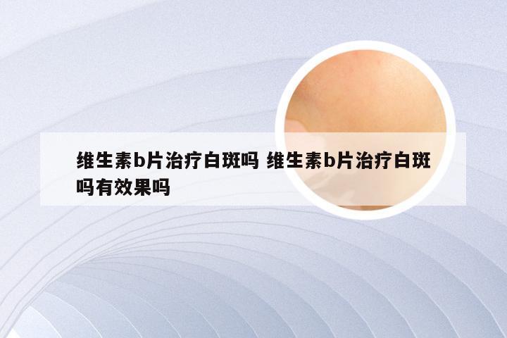 维生素b片治疗白斑吗 维生素b片治疗白斑吗有效果吗