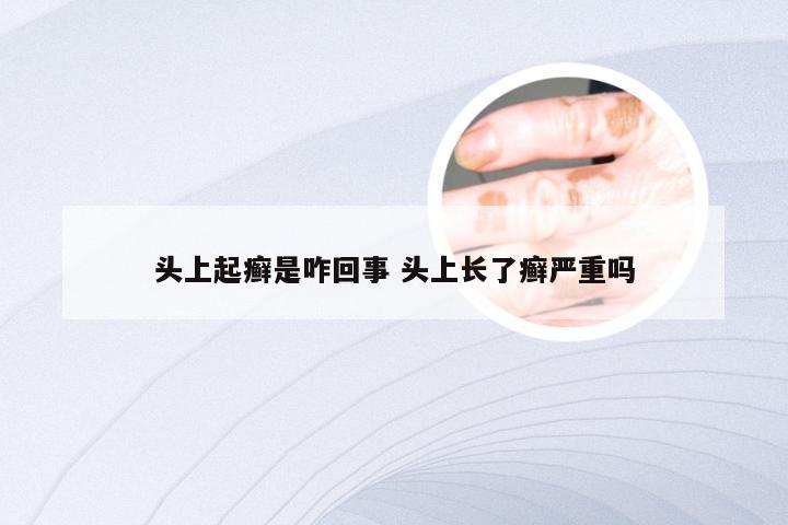 头上起癣是咋回事 头上长了癣严重吗