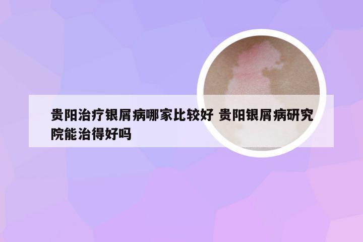 贵阳治疗银屑病哪家比较好 贵阳银屑病研究院能治得好吗