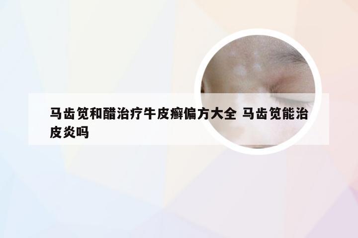 马齿笕和醋治疗牛皮癣偏方大全 马齿笕能治皮炎吗