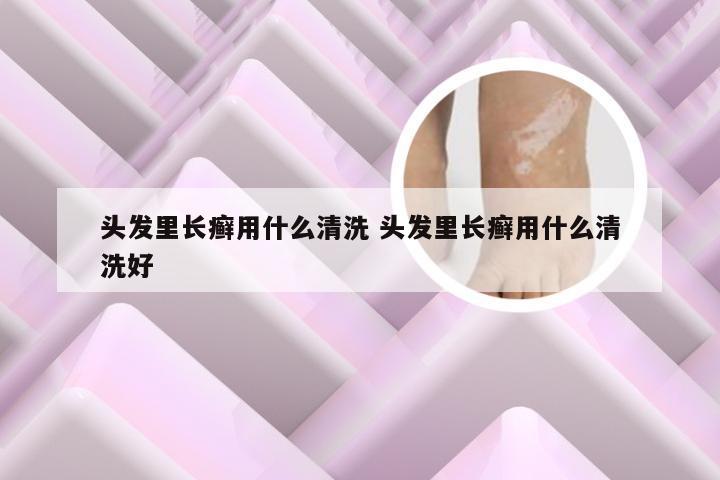 头发里长癣用什么清洗 头发里长癣用什么清洗好