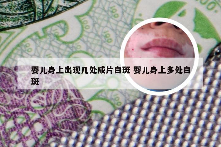 婴儿身上出现几处成片白斑 婴儿身上多处白斑