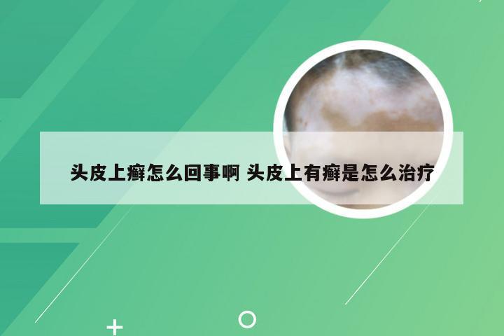 头皮上癣怎么回事啊 头皮上有癣是怎么治疗