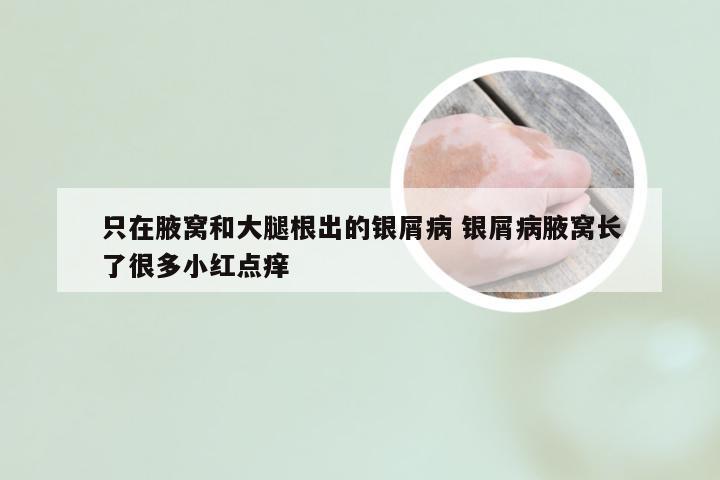 只在腋窝和大腿根出的银屑病 银屑病腋窝长了很多小红点痒