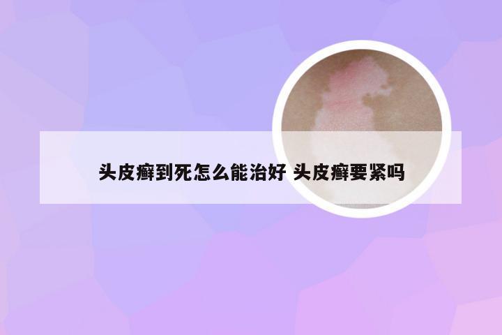 头皮癣到死怎么能治好 头皮癣要紧吗