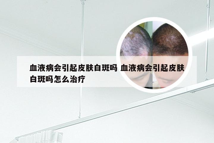 血液病会引起皮肤白斑吗 血液病会引起皮肤白斑吗怎么治疗