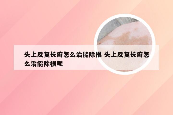 头上反复长癣怎么治能除根 头上反复长癣怎么治能除根呢