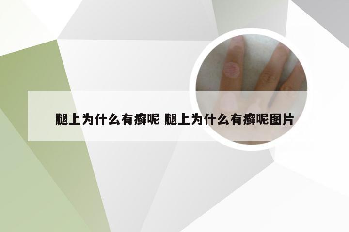 腿上为什么有癣呢 腿上为什么有癣呢图片