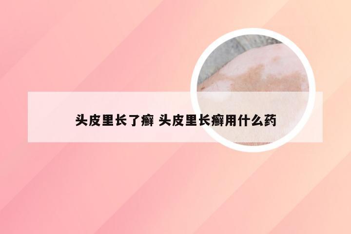 头皮里长了癣 头皮里长癣用什么药