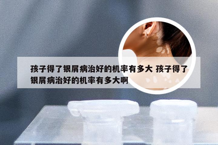 孩子得了银屑病治好的机率有多大 孩子得了银屑病治好的机率有多大啊