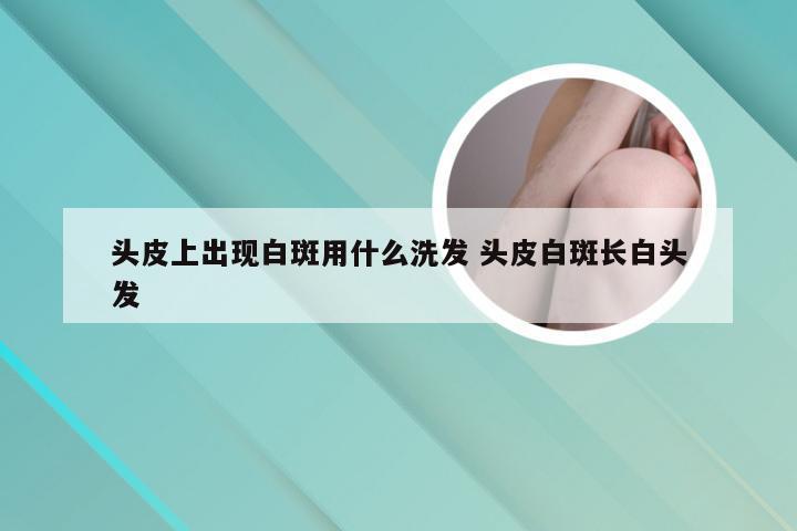 头皮上出现白斑用什么洗发 头皮白斑长白头发