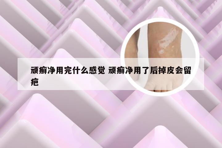 顽癣净用完什么感觉 顽癣净用了后掉皮会留疤