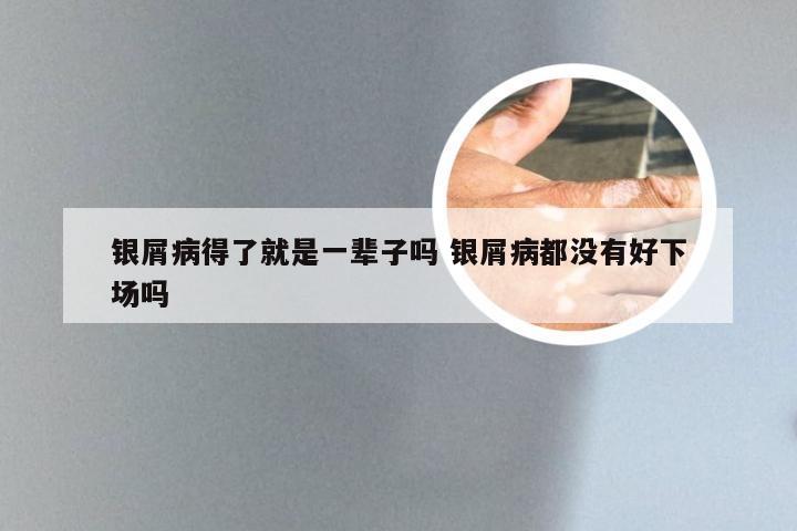 银屑病得了就是一辈子吗 银屑病都没有好下场吗